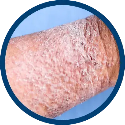 Atopic Dermatitis